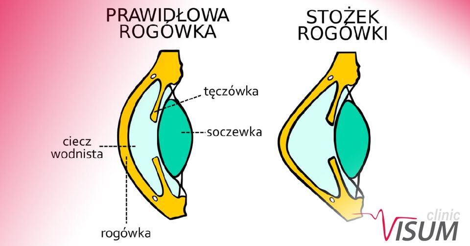 stożek rogówki 